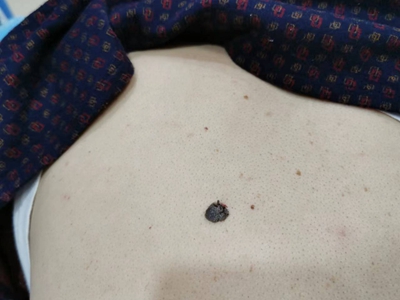 脂溢性角化病症状图片
