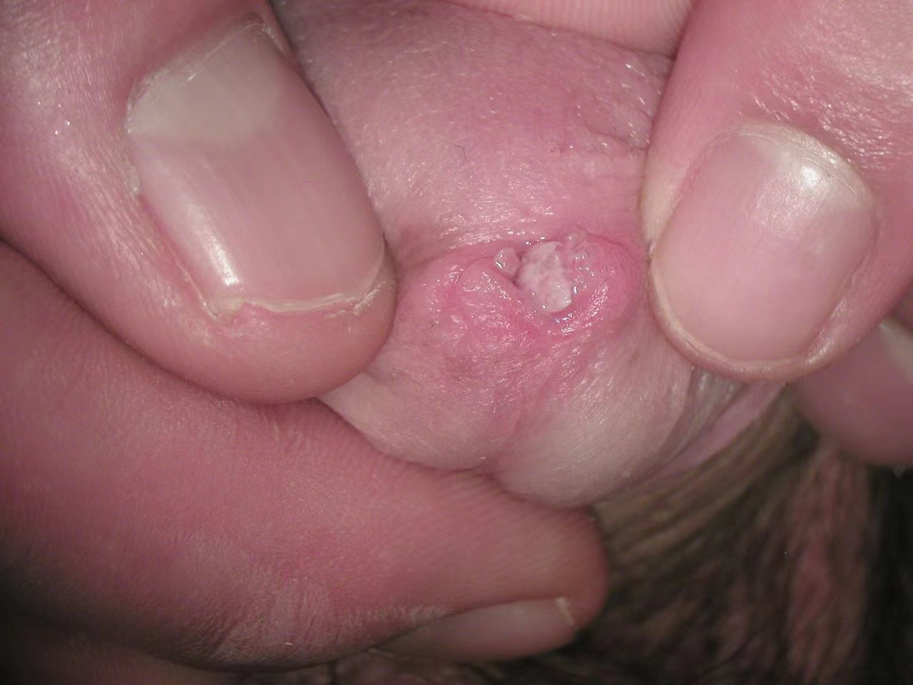 男性尿道尖銳濕疣 (48)