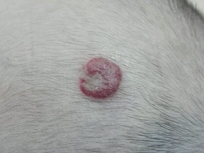 jpg 浅表型婴儿血管瘤头上有一个红色疙瘩图.jpg