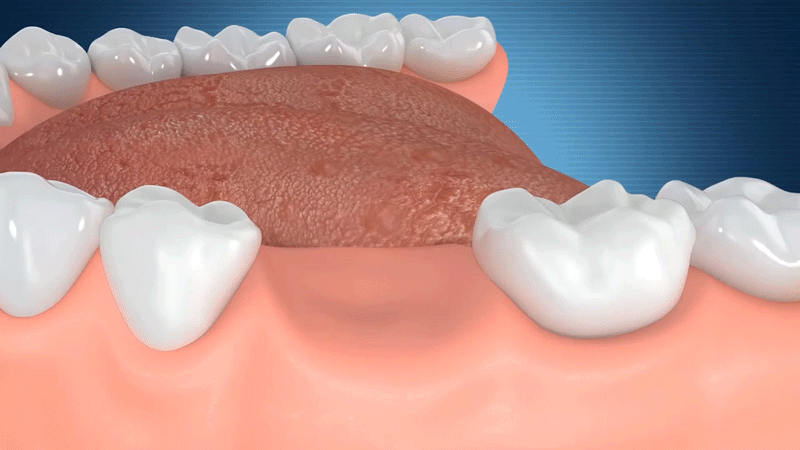 gif 冠类义齿.gif