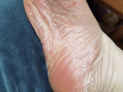 jpg 鳞屑角化型足癣脚底脱皮有裂纹图.jpg