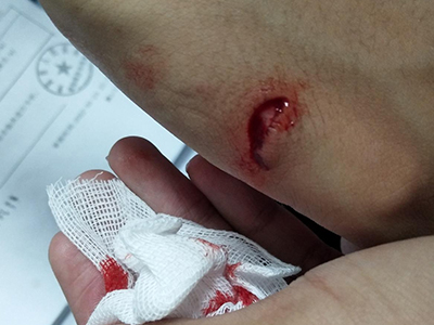 jpg 划伤手背流血图.jpg