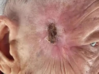 jpg 头部鳞状细胞癌面部结焦痂图.jpg