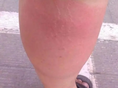 jpg 细菌感染性淋巴水肿小腿红肿有小疙瘩图.jpg