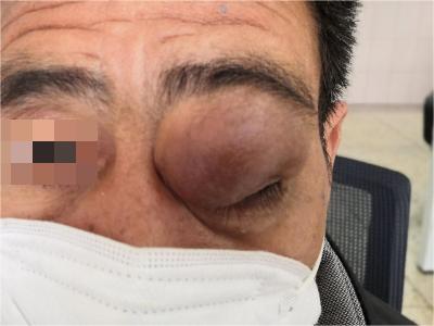 jpeg 眼眶神经鞘瘤左眼眶上有一个大肿块图.jpeg