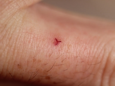 jpg 水蛭咬伤手指有个Y形裂口发红图.jpg