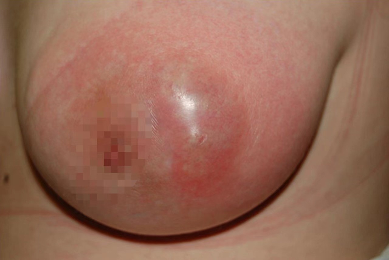 女性乳腺炎图片