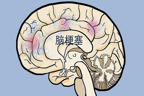 脑梗塞.jpg