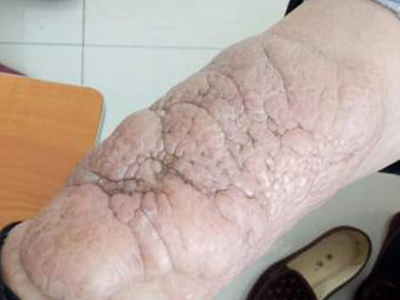 jpeg 胫前黏液性水肿小腿有大面积肿块图.jpeg