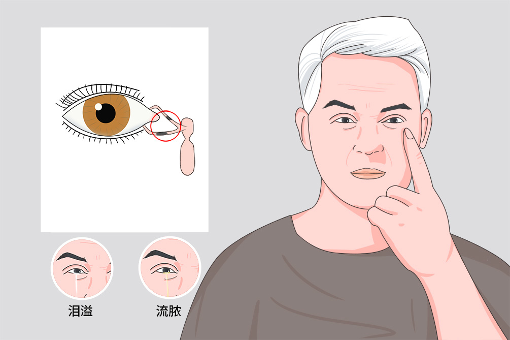 passage,slp 是否常见 是 是否遗传 否 并发疾病 泪小管炎,慢性泪