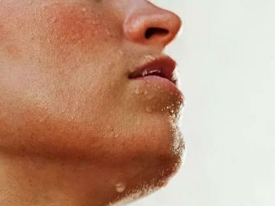 jpg 局限型多汗症脸上出汗有汗珠图.jpg