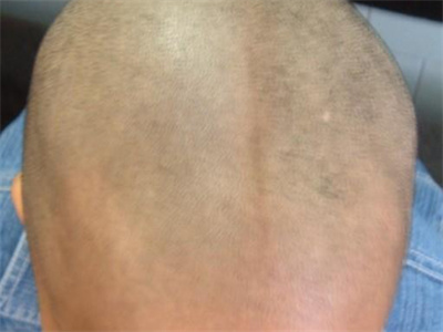 jpg 帽状腱膜下血肿头顶左侧有肿胀包块图.jpg