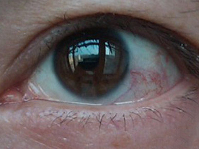 jpg 干眼症眼球上有红血丝图.jpg