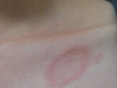 jpg 离心性环状红斑胸前有一块环状的红斑图.jpg