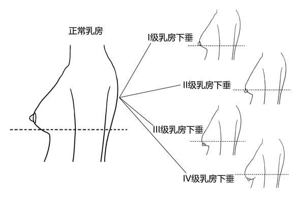 如何判断胸部下垂