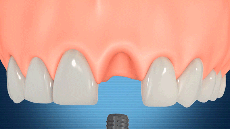 gif 种植义齿.gif