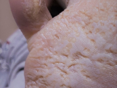 jpg 窝状角质松解症脚底皮肤发白有小坑图.jpg