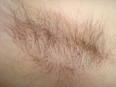 jpeg 阴虱病腋窝有红棕色小斑点图.jpeg