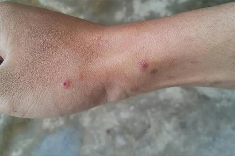 jpg 猫抓病手腕周围出现红色丘疹图.jpg