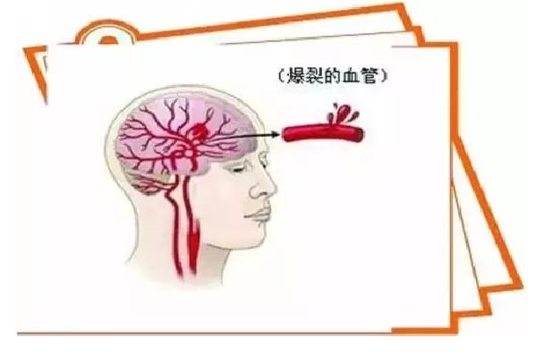 脑出血.png