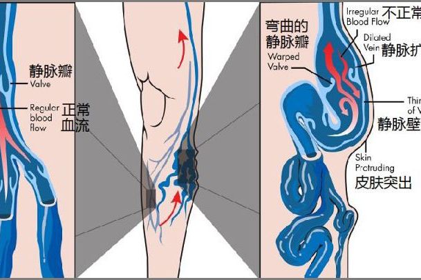 什么是精索性静脉曲张