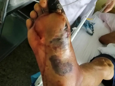 湿性坏疽症状图片