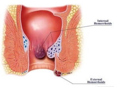 內(nèi)痔瘡 (52)