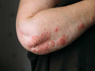 jpg 关节病型银屑病肘部长红斑图.jpg