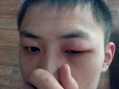 接触性睑皮炎症状图片