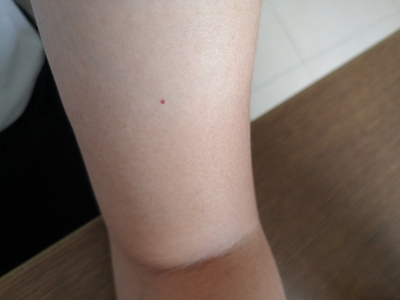 jpeg 樱桃状血管瘤胳膊一个小红点图.jpeg