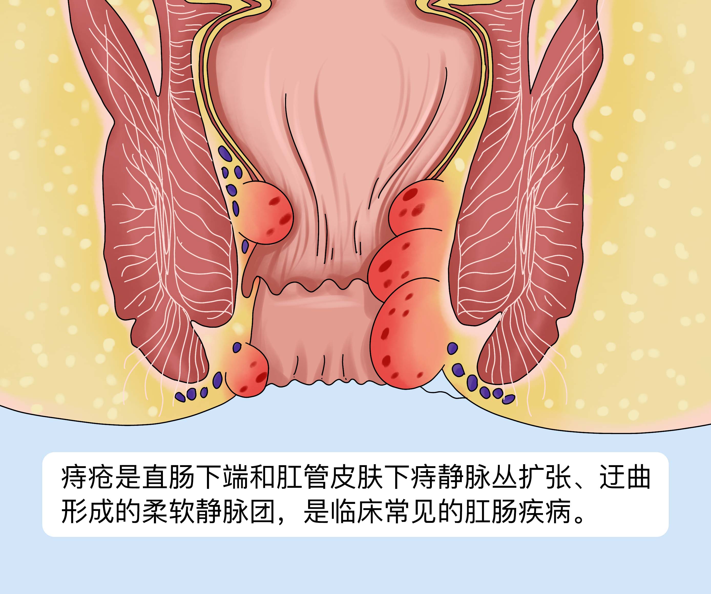 jpg 痔疮什么意思.jpg