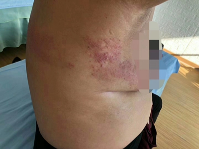带状疱疹症状图片