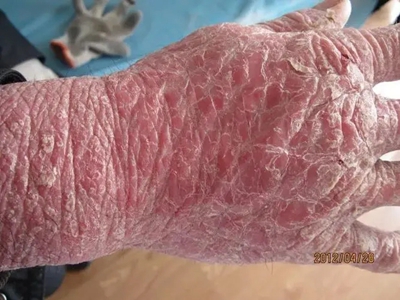 jpg 红皮病脱屑期手背部粗糙有裂纹图.jpg