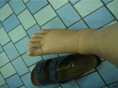 特發(fā)性水腫右腳增大腳腕增粗有勒痕圖.jpg