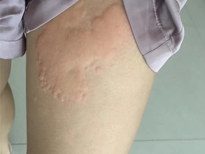 jpg 荨麻疹型药疹大腿根部有一大片风团图.jpg