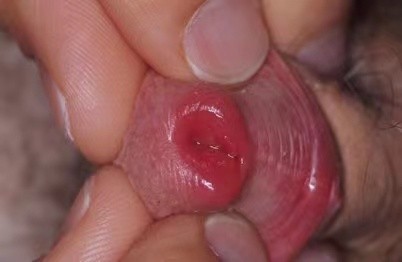 男性尿道尖銳濕疣 (40)