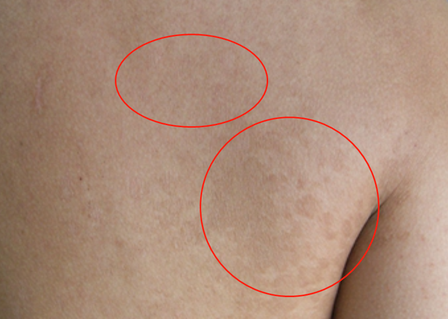 png 花斑糠疹后背有好多褐色的点状斑疹图.png
