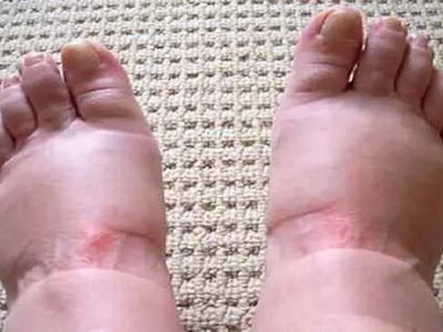 特發(fā)性水腫雙腳嚴重脹大有明顯鞋印圖.jpg