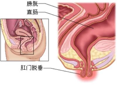 脫肛圖片 (32)