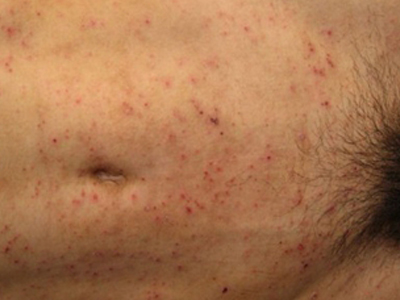 jpg 疥疮下腹部上长红疹抓挠结痂图.jpg