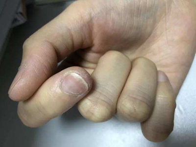 jpg 缺铁性贫血指甲变薄干燥图.jpg