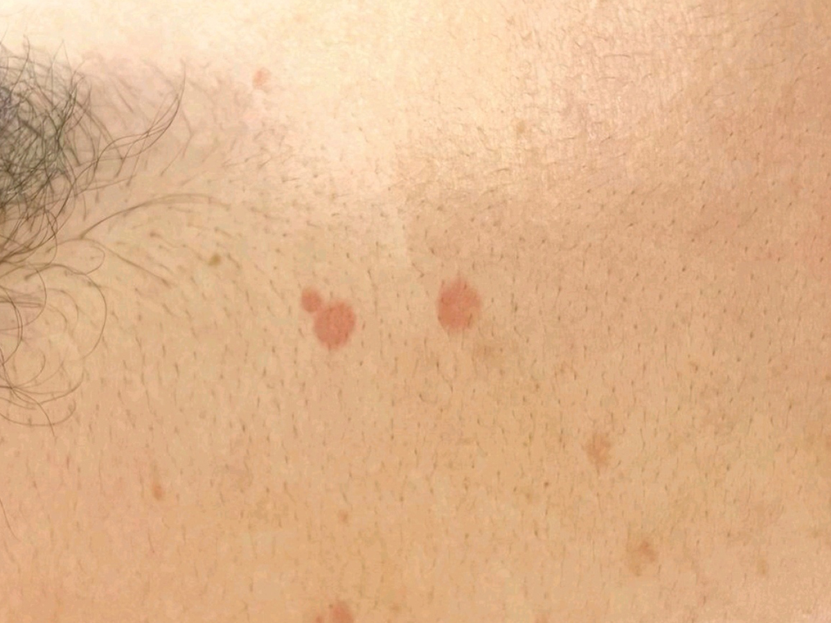 夏季汗斑应该如何预防?