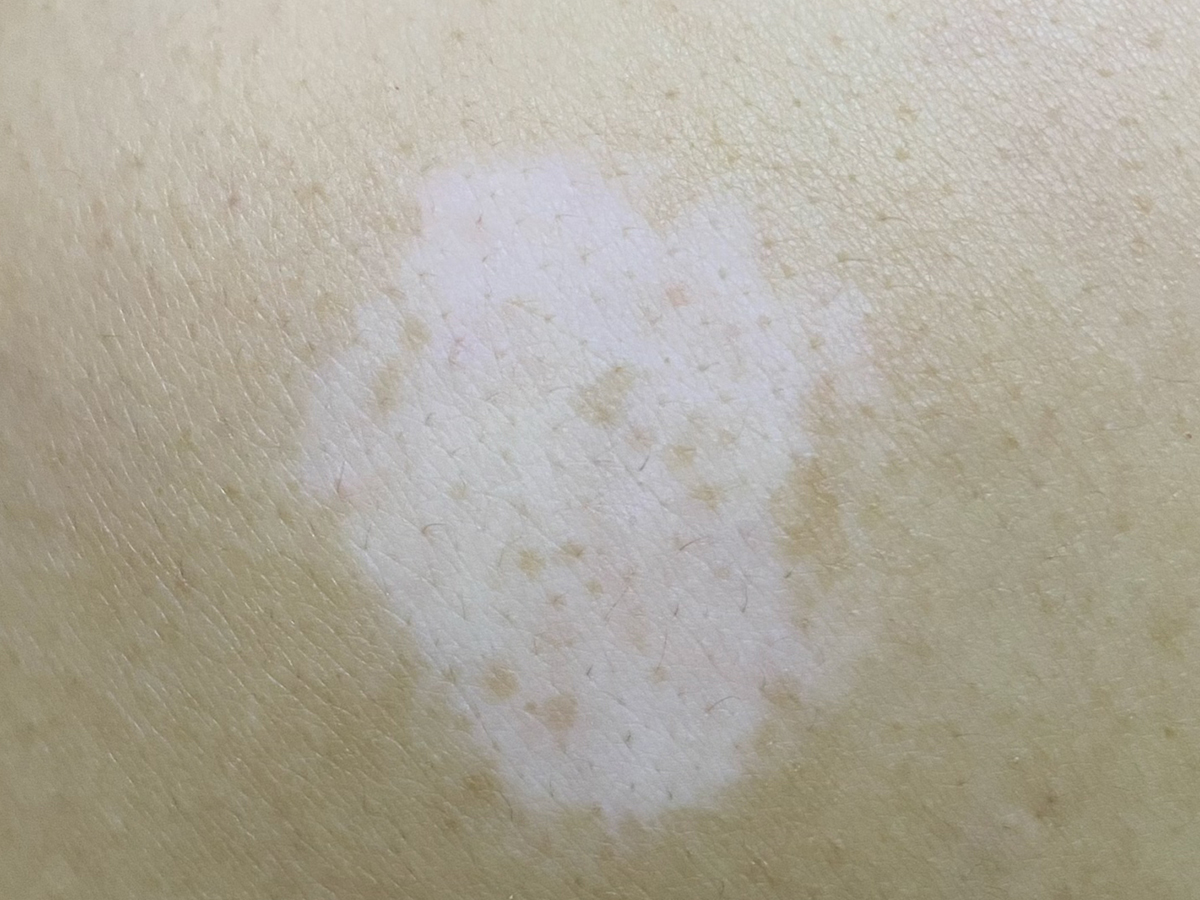 如何预防白斑的发生？