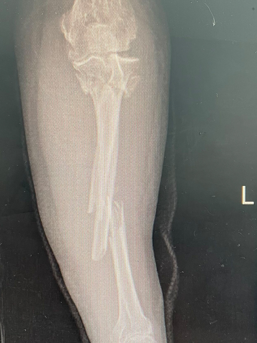 稳定性骨折严重吗 3552_1657162644_257.jpg