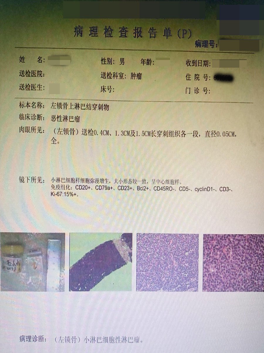 小淋巴细胞性淋巴瘤是什么 4606_1658976515_664.jpg