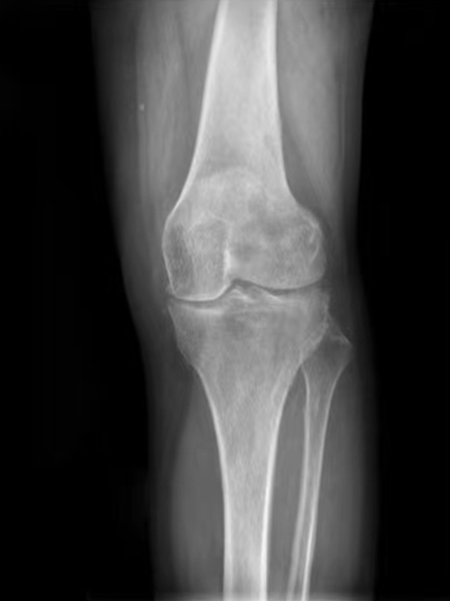 膝盖滑膜炎怎么治疗才能好 9329_1661312290_188.jpg