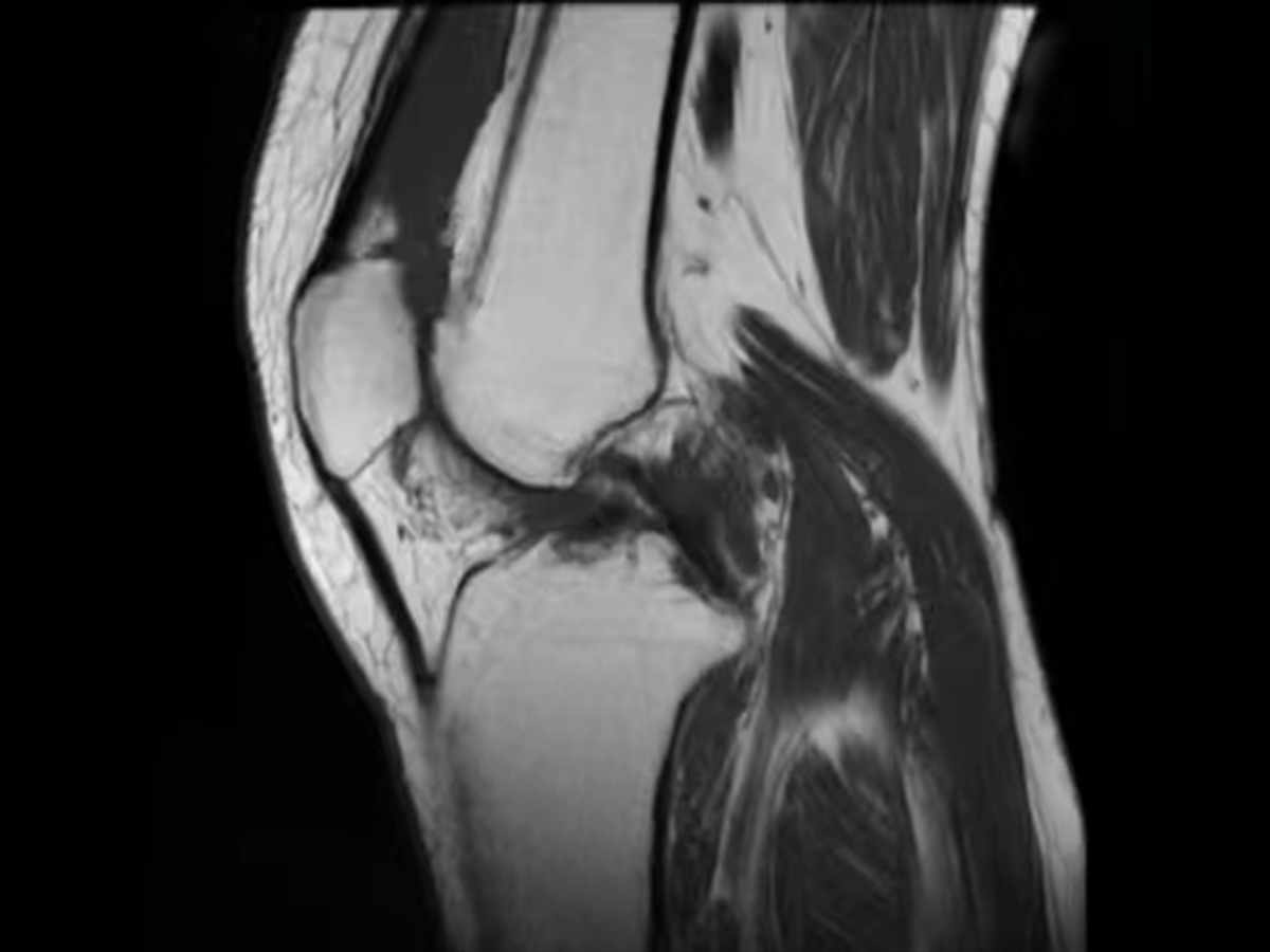 膝盖滑膜炎怎么治疗才能好 9330_1661312291_207.jpg