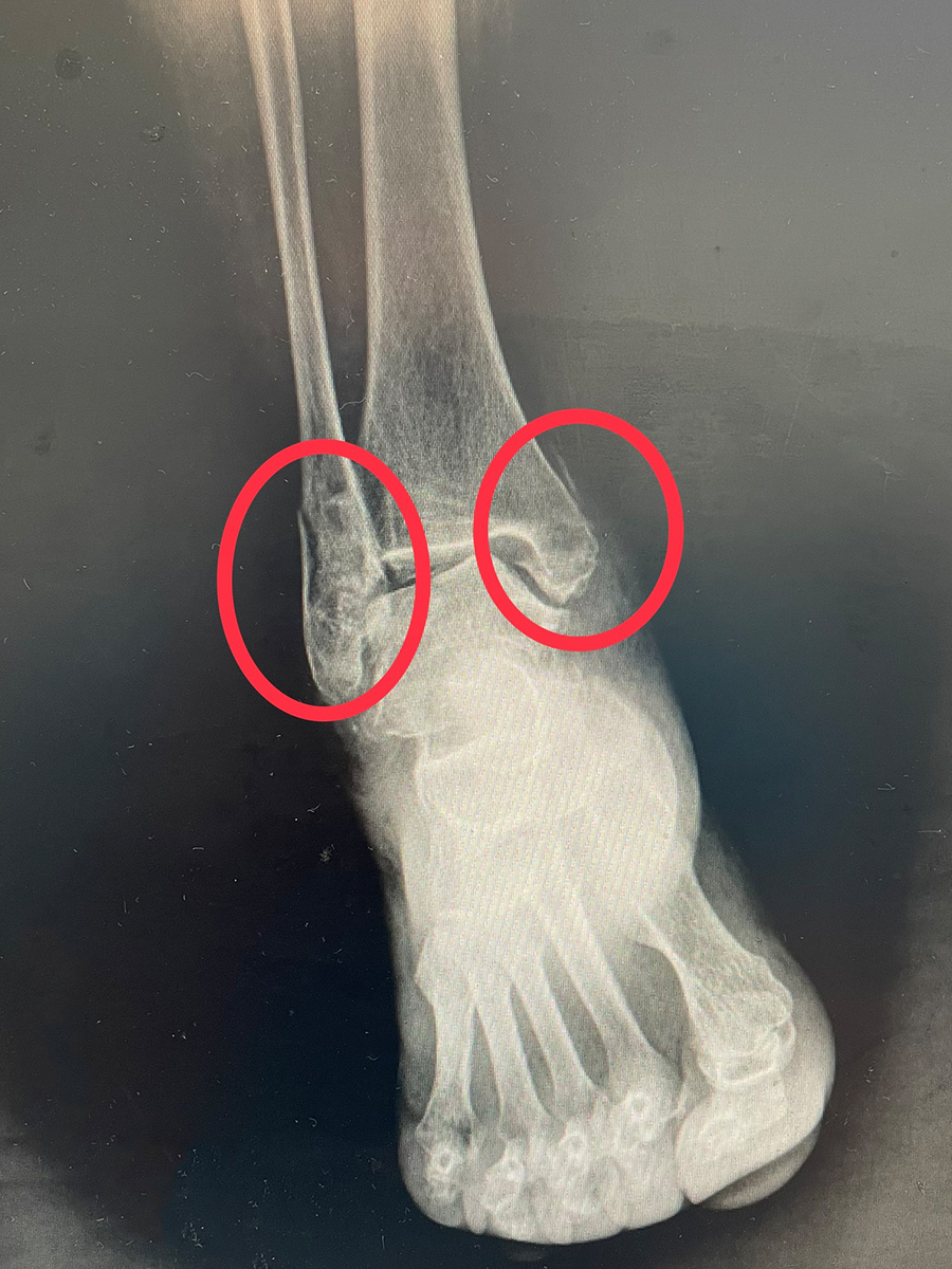 稳定性骨折是什么骨折 7484_1666578430_668.jpg