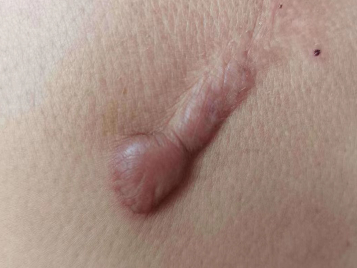 为什么胸前容易长疤痕呢?