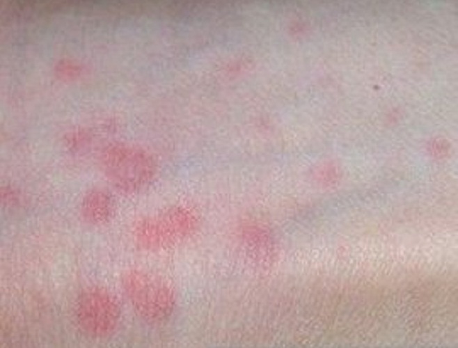 荨麻疹辨别图片